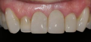bBioclear complex case after
