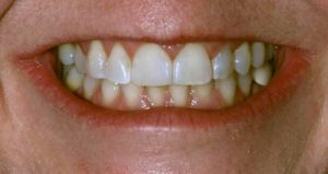 bBioclear diastema case after