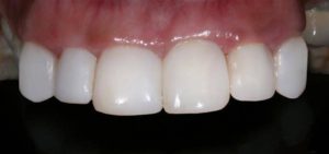 dBioclear comprehensive case 2 after-b