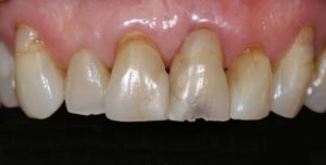 aBioclear complex case before