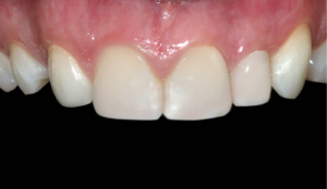 bBioclear peg lateral case after