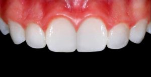hBioclear dark triangle case 4 after
